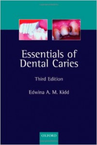 Essentials of Dental Caries The Diseases And its Management